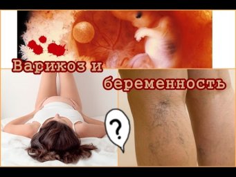 Варикоз во время беременности Варикоз во время беременности