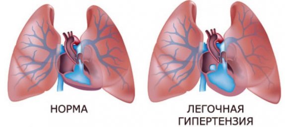 Легочная гипертензия – симптомы болезни, лечение