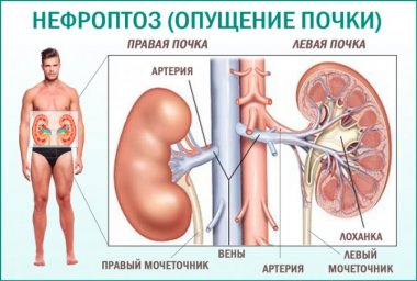 Как лечить опущение почек?